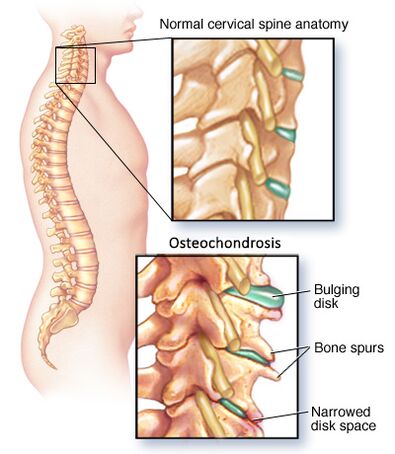 ostéochondrose cervicale