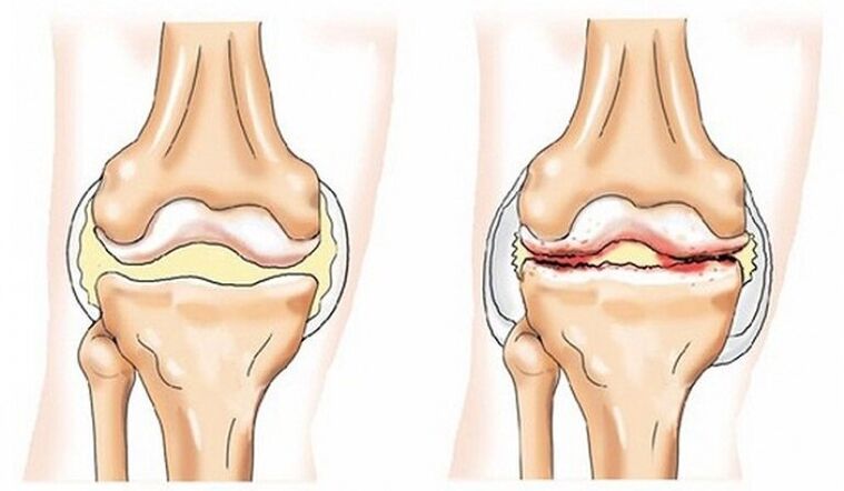 Articulation saine et conjointe affectée par l'arthrose