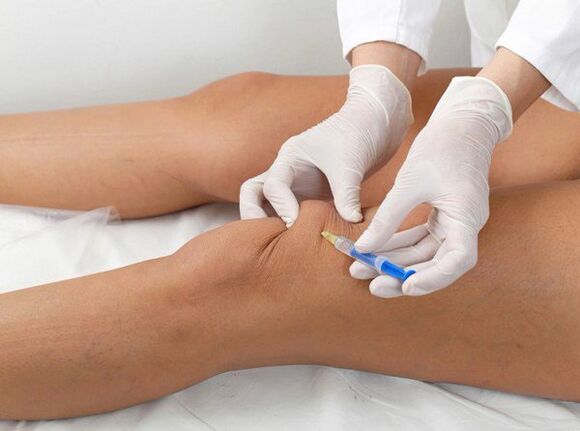 injection intra-articulaire pour l'arthrose du genou